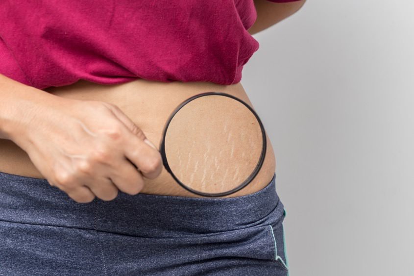 stretch-marks