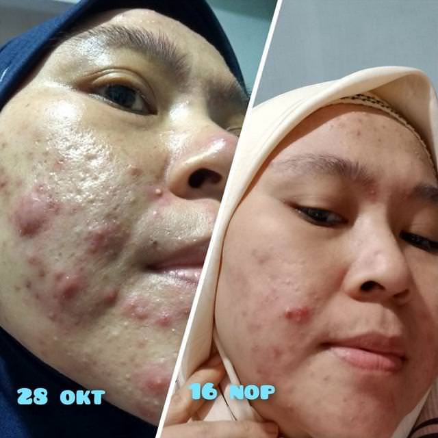 reglow-testimoni-jerawat-2
