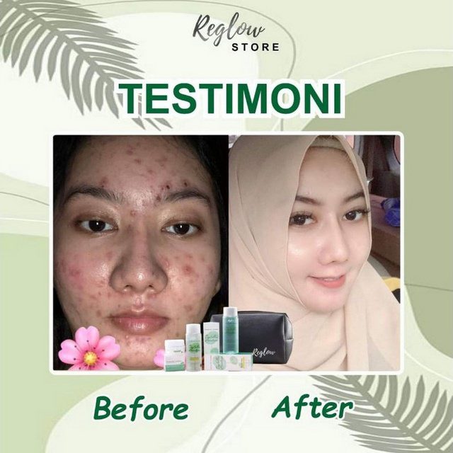 reglow-testimoni-jerawat-3